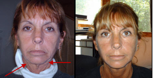 What are some face exercises for sagging jowls?