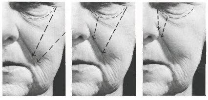 Facial exercise for nasolabial folds